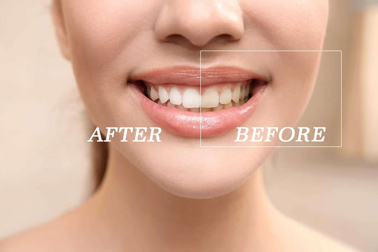 What Are the Most Effective Natural Teeth Whitening Methods You Can Try Peterborough?