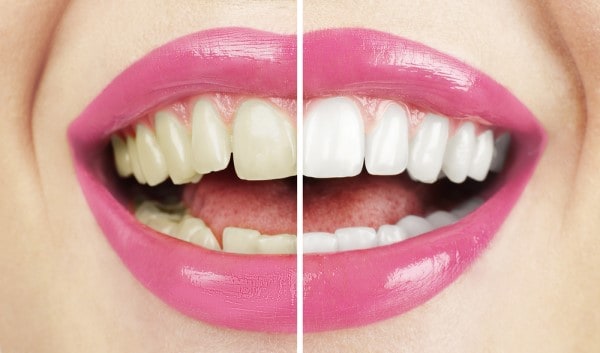 What Makes Ultima White Teeth Whitening Different Peterborough