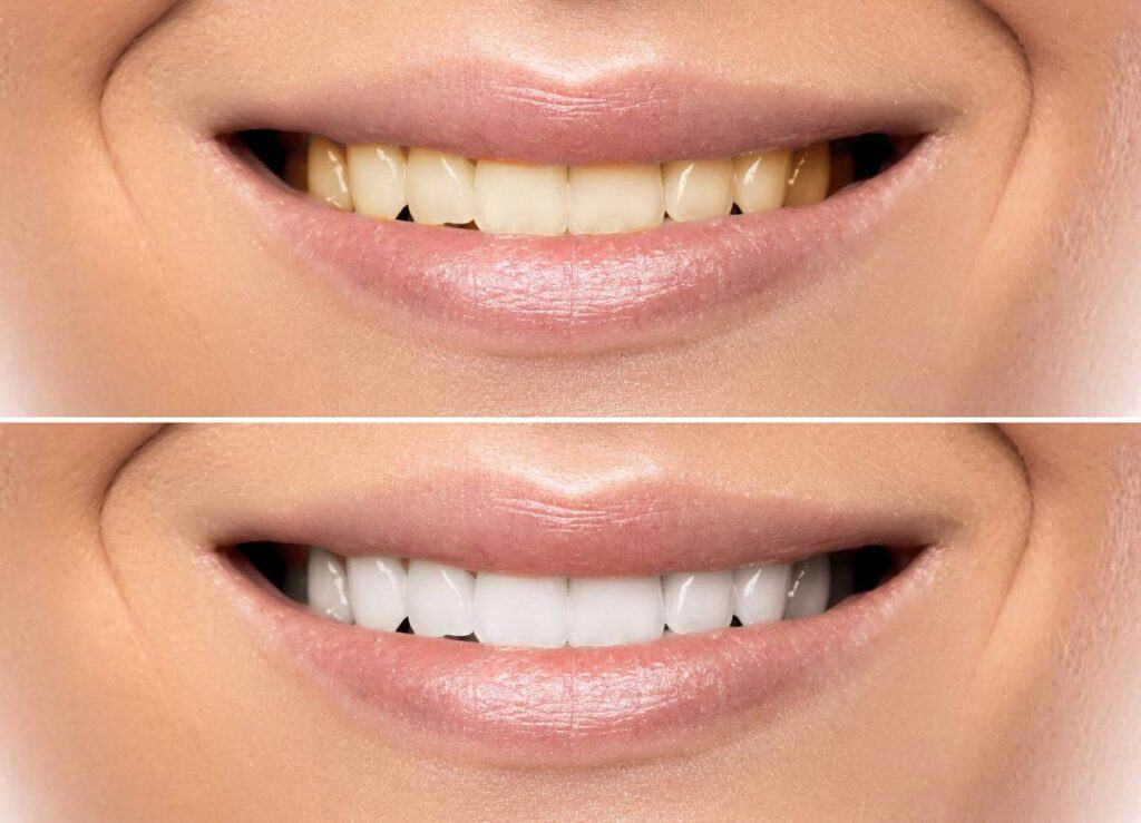 How Can You Protect Your White Smile as a Coffee Lover Peterborough?