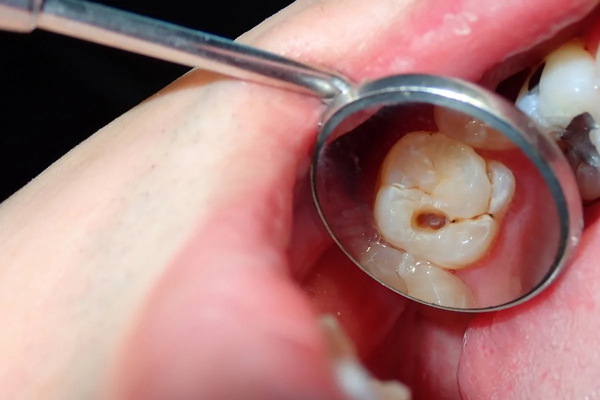 Why Do Teeth Crack? Common Causes to Know Peterborough
