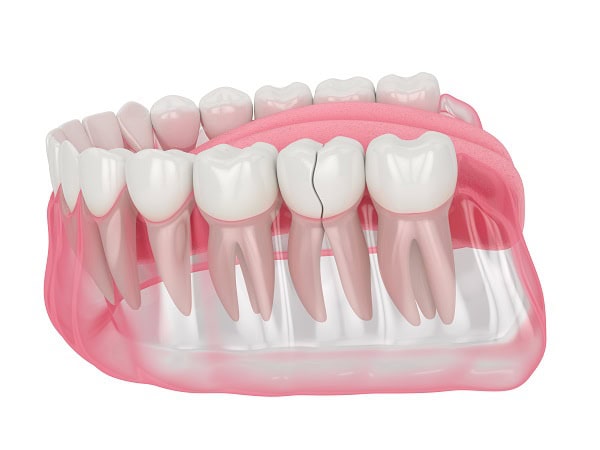 How Can You Manage Pain and Discomfort After a Root Canal Peterborough?