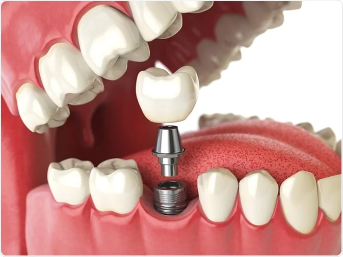 How Do I Decide Which Tooth Replacement Is Right for Me Peterborough?