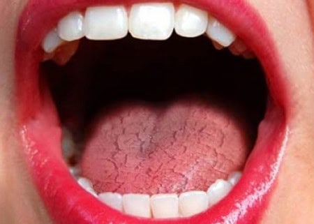 Dry Mouth and Its Role in Tooth Decay Peterborough