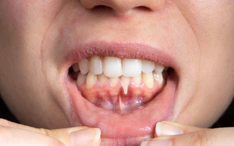 How Can Gum Disease Be Prevented Peterborough?