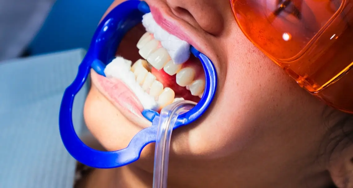 How Teeth Whitening Treatments Actually Work on Your Enamel Peterborough