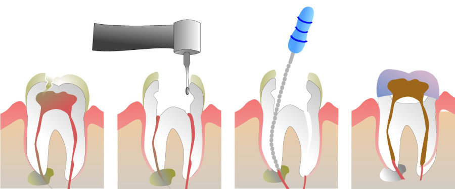 How Do You Properly Care for Your Teeth After a Root Canal Peterborough