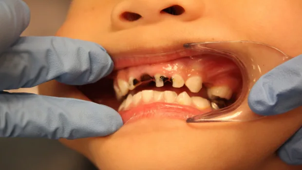 Which Foods and Drinks Cause the Most Damage to Young Smiles Peterborough?