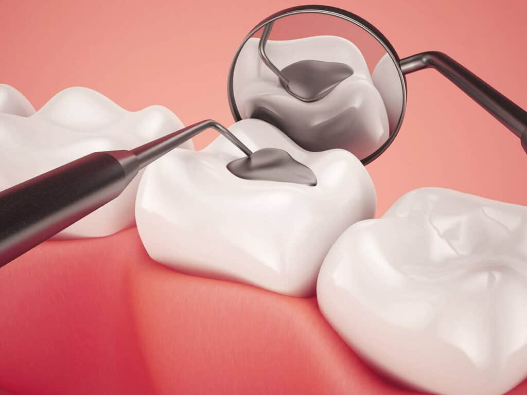 How Can You Prevent Tooth Decay Effectively Peterborough