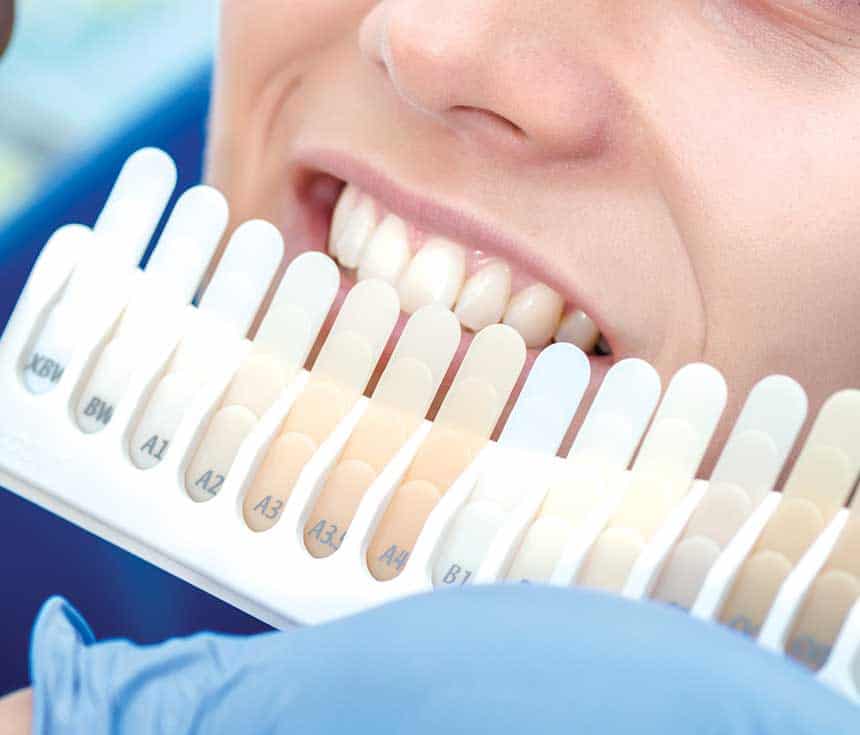 Is Laser Teeth Whitening Worth It for a Brighter, Confident Smile Peterborough?