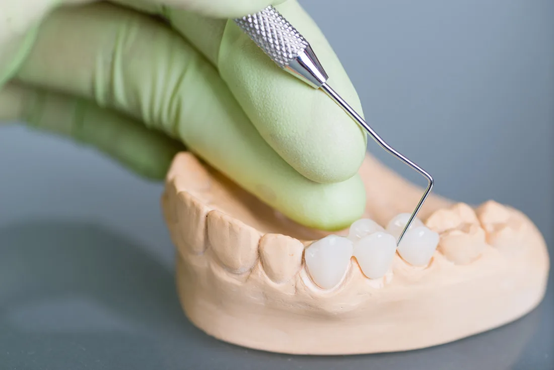 What Are the Different Types of Dental Crowns Available Peterborough?