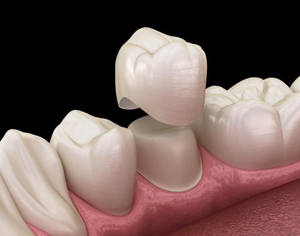 How Can You Prevent Common Dental Crown Problems Peterborough?