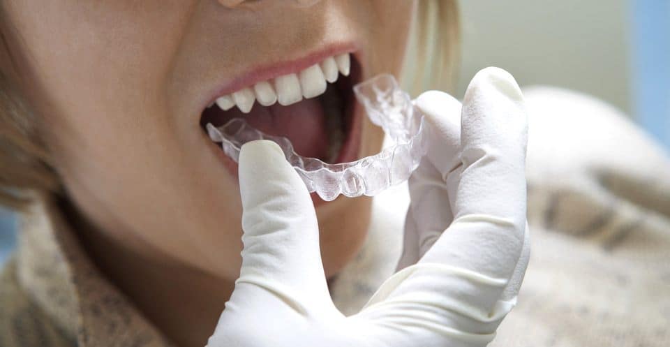 How Much Does Laser Teeth Whitening Cost Compared to Overnight Trays Peterborough?