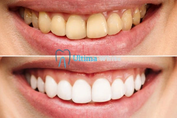 Oral Care Tips for Current and Former Smokers Peterborough