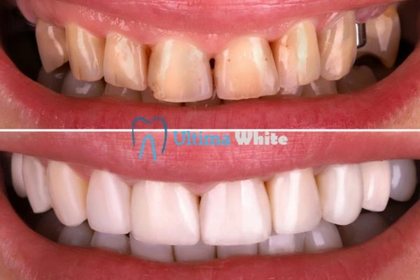 What Makes Instant Teeth Whitening Treatments So Popular Peterborough?