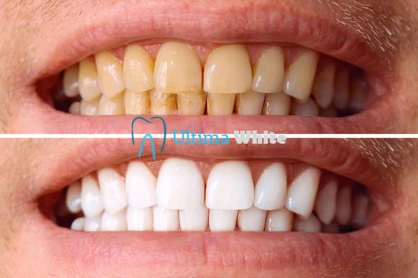 Stained Teeth and Persistent Bad Breath Peterborough