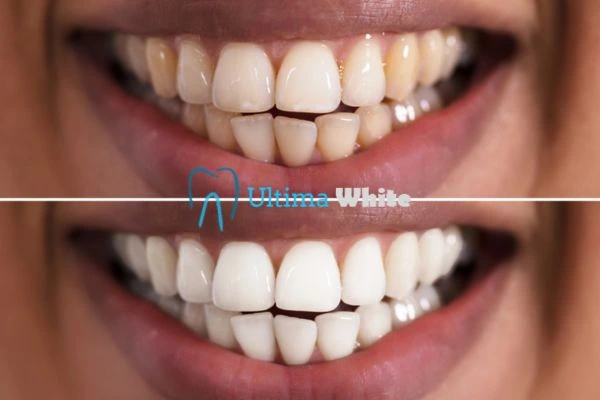 Aftercare Tips to Maintain Your New Smile Peterborough